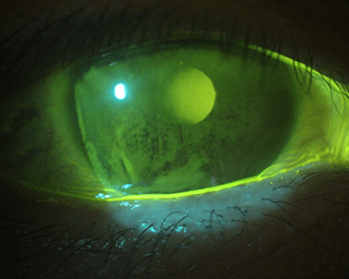 Dry-Eye-Screening-Management