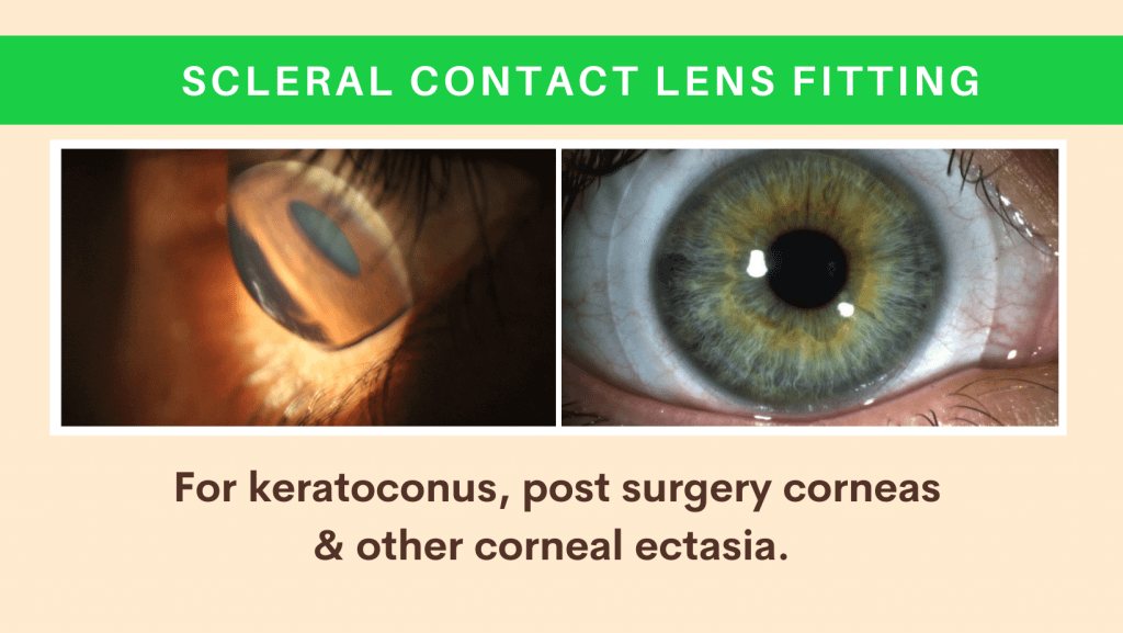 Scleral Contact Lens and Kerasoft IC Fitting for Keratoconus - Gold ...