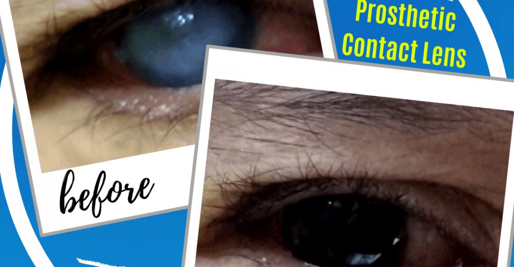 Prosthetic Contact Lenses Gold Heart Optical Centre