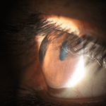eye with keratoconus can Have 20/20 Vision