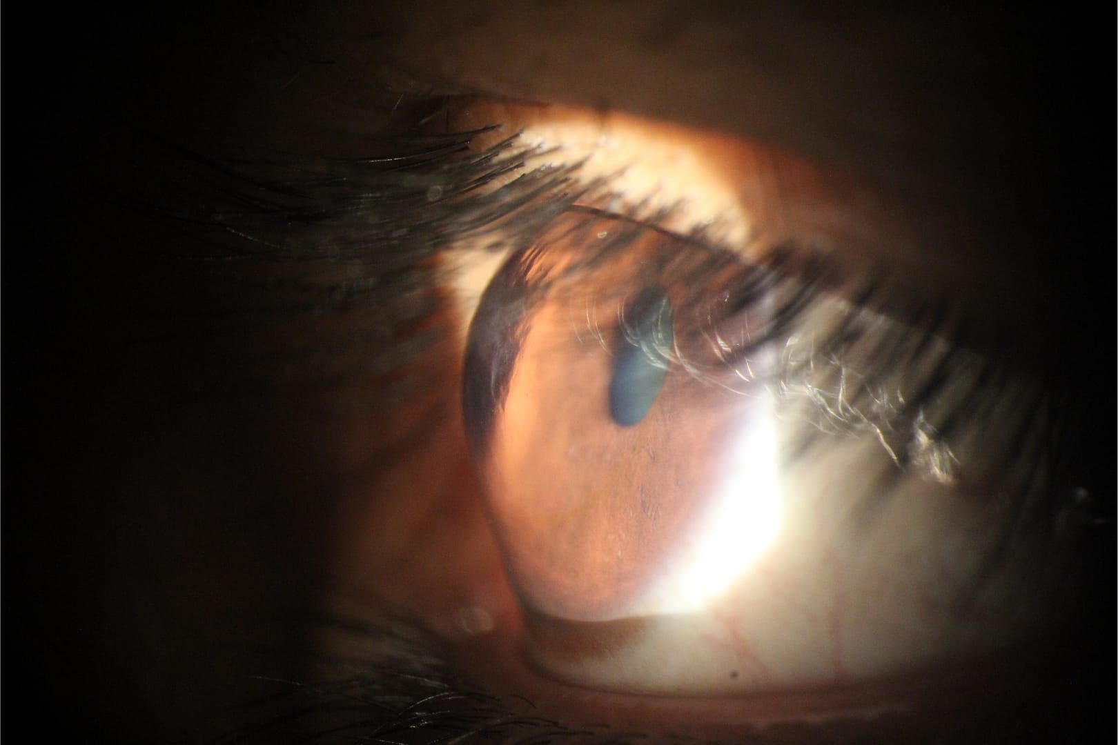 eye with keratoconus can Have 20/20 Vision