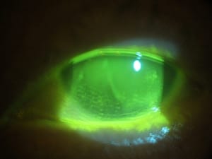 Photo of a patient with Sjögren's syndrome wearing Scleral Contact Lens