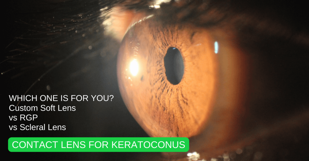 Contact Lens for Keratoconus Soft Custom Lens vs RGP vs Scleral Lenses